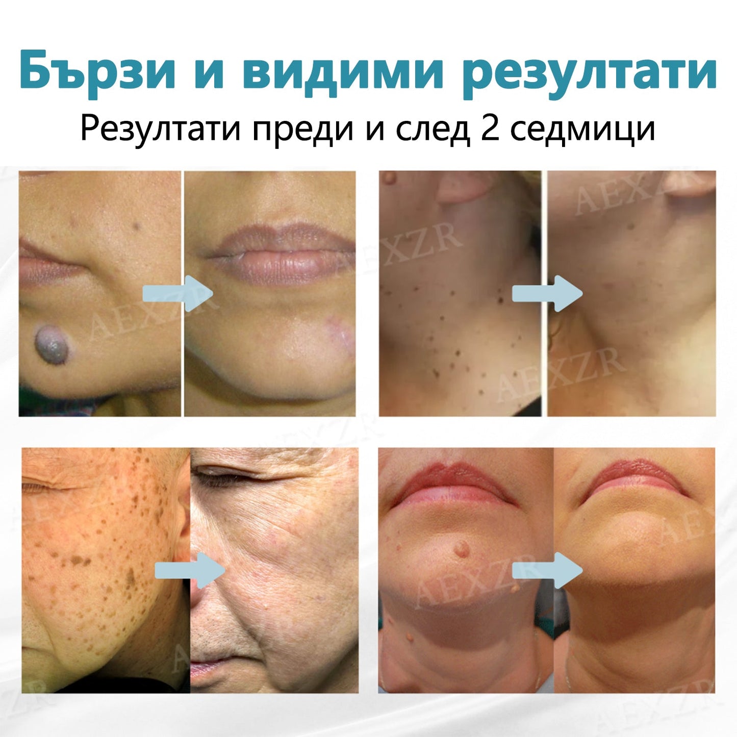 🌟Bikenda® Неинвазивна лазерна писалка за премахване на бенки и брадавици